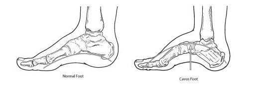 Pes Cavus [1]