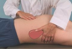 Patient supine with therapist on the right side of the patient, reaching across, elevating rib to create slack at the costal margin, and palpating just below the ribs for spleen enlargement during inspiration.