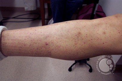 Example of petechaie present in this patient.