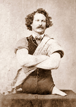 Example of a person with Phocomelia