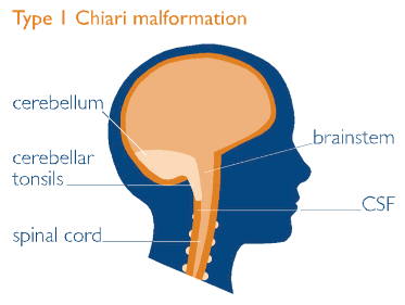 Thanks to Brain & Spine Foundation for permission to use images.