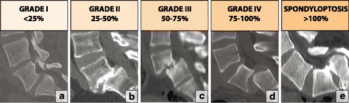 X-ray representation of the Meyerding Classification of Spondylolisthesis