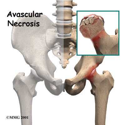 Avascular Necrosis