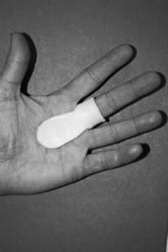 MCP Splint on Hand