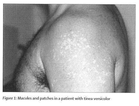 Image:Tinea_versicolor.jpg