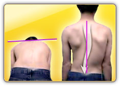 Adam Forward Bend test illustration