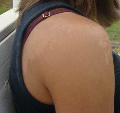 Image:Tinea_versicolor_of_right_shoulder.jpg