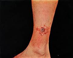 http://www.upmc-biosecurity.org/website/focus/agents_diseases/fact_sheets/tularemia.html
