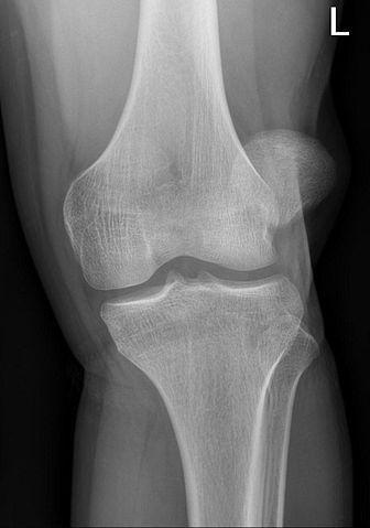 patella malalignment