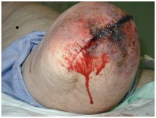 Tissue necrosis