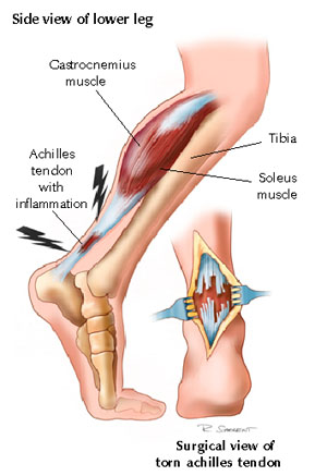 Fig. 2: Achilles Tendon Rupture