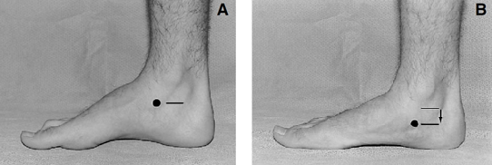 Navicular Drop Test
