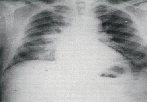 http://cchealth.org/topics/bioterrorism/providers/how_to_recognize.php