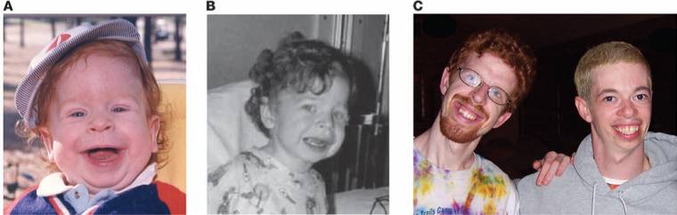 Facial characteristics of children and adults with William's Snydrome