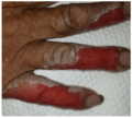 White areas in periwound demonstrate maceration.