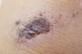 Image of a scab for comparison with eschar.