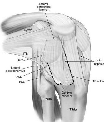 Anterolateral view of a right knee - Iliotibial band (ITB), anterolateral ligament (ALL), FCL, fibular collateral ligament; PLT, popliteus tendon.