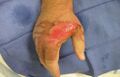 Superficial partial burn wound