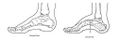 Pes cavus