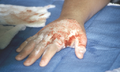 Petechiae on back of hand