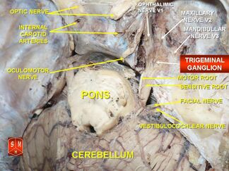 https://commons.wikimedia.org/wiki/File:Trigeminal_ganglion.jpg