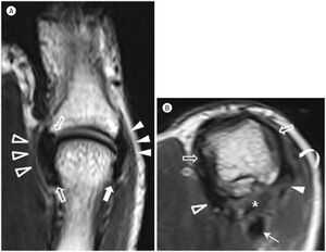 A. The T2-weighted coronal image shows the ulnar collateral ligaments (empty arrows) and the closely apposed, superficial aponeurosis of the adductor pollicis longus (empty arrowheads). A similar spatial relationship exists with the radial collateral ligament (arrows) and the superficial tendon of the abductor pollicis brevis (arrowheads).B. The T2-weighted axial image depicts the main collateral ligaments (empty arrows), accessory collateral ligament (arrowhead), aponeurosis of the adductor pollicis longus (empty arrowhead), tendon of the abductor pollicis brevis (curved arrow), intersesamoid ligament (asterisk), and flexor pollicis longus tendon (thin arrow).