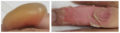 Left image: blister intact. Right image: deroofed blister