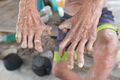 Claw finger deformities, palmer view
