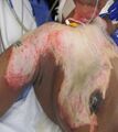 Full thickness burn wound