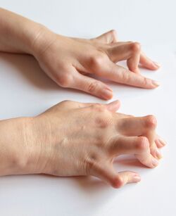 Boutonniere deformity