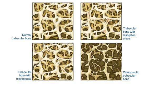 Cancellous bone - Trabecular bone - Normal trabecular bone Trabecular bone