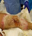 Subcutaneous burn wound