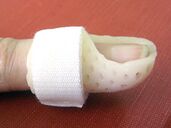 Image showing mallet finger splint applied