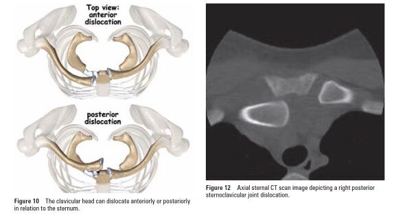 Figures adapted from: Bontempo N, Mazzocca A. Biomechanics and treatment of acromioclavicular and sternoclavicular joint injuries. British Journal of Sports Medicine. April 2010;44:361-369