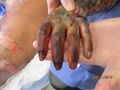 Subcutaneous burn wound