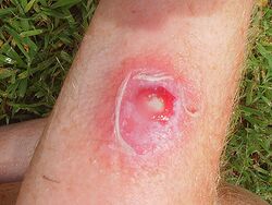 MRSA infection.