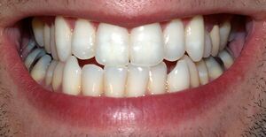 A man smiling revealing his teeth