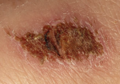 Scab
