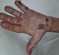 Superficial partial burn wound