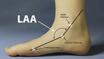 Longitudinal Arch Angle