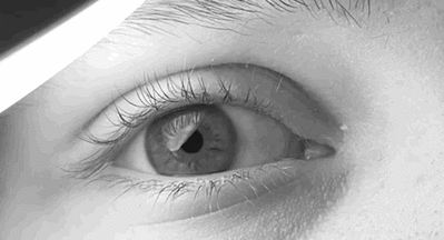 Image 1: Left eye of male with congenital nystagmus in a rapid horizontal motion.