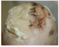 Dry fissured skin. Photo provided by and used with kind permission from Diane Merwarth PT.