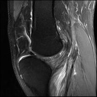 Congenital-absence-of-anterior-cruciate-ligament222