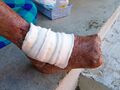 Leprosy-related amputation of the toes
