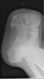 Transmetatarsal amputation