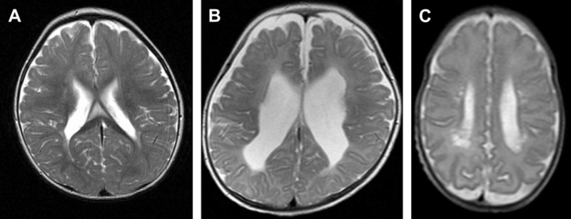Periventricular Leukomalacia Grading 1,2 and 3 (left to right)