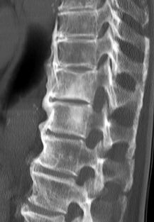 Flowing Ossification