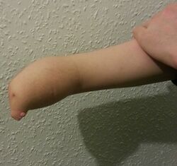 Amelia right forearm