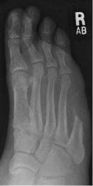 5th ray amputation