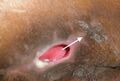 Arrow denotes direction of sinus tract
